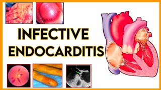 infective endocarditisetiologypathogenesisclassificationsign and symptomdiagnosis and treatment [upl. by Haywood]