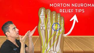 Relieve Morton’s Neuroma Pain Best Tips and Tricks [upl. by Ainorev]