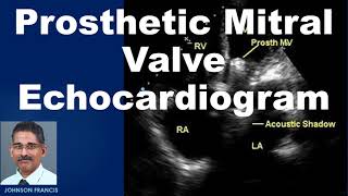 Prosthetic Mitral Valve Echocardiogram [upl. by Nami]