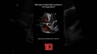 Echocardiography Question 1 [upl. by Hteboj]