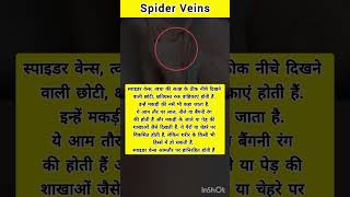 Whats the Spider Veins  healthfacts medicalfacts medicalcondition spiderveins health disease [upl. by Liza244]