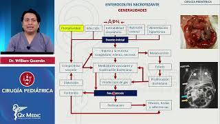 Enterocolitis necrotizante CIRUGÍA PEDIATRÍA INDICE DESCRIPCIONETIOLOGIACLINICATTO QXMEDIC [upl. by Broddy]