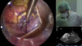 Totally Endoscopic Aortic Valve Replacement [upl. by Clothilde694]