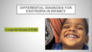 Esotropia Enigma Understanding and Managing Childhood Strabismus [upl. by Lud914]