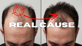 Male Pattern Baldness  REAL Underlying Cause Explained Galea Aponeurotica [upl. by Badger]