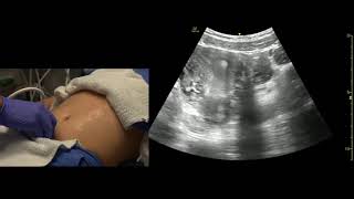 Transabdominal Pelvis Ultrasound Scanning Techniques [upl. by Andee]