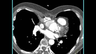 Cardiac Pseudoaneurysm of ascending aorta 2 of 5 [upl. by Nodlew]