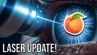 LASER Surgery Update  Hemorrhoids Anal Fistula Pilonidal Cyst [upl. by Tila]