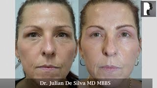 Blepharoplasty Review only 1week after surgery with Dr Julian De Silva [upl. by Felic4]