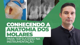 Instrumentação Mecanizada  Aprofundando a Anatomia dos Molares [upl. by Gerg]