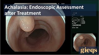 Achalasia Endoscopic Assessment after Treatment [upl. by Damien766]