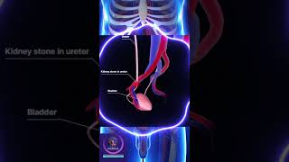 Kidney Stone In The Ureter shorts education [upl. by Kciredohr324]