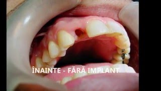 Implant dentar rapid  GM Clinic Timisoara [upl. by Lodie]