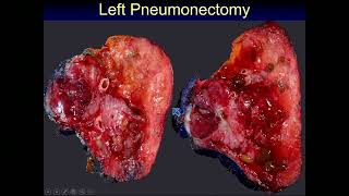 Neuroendocrine Tumors of the Lung Current Diagnostic Criteria amp Controversies by Carol Farver MD [upl. by Broeker542]