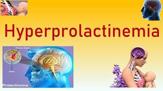 Hyperprolactinemia  Causes Symptoms Clinical Features Diagnosis Investigations and Management [upl. by Egap]