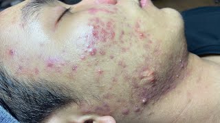 ACNE TREATMENT VU QUYNH MI Blackheads On Boy Face 2024 [upl. by Arda]