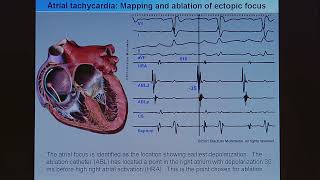 10 Ablation der atrialen Tachykardie [upl. by Eeluj]