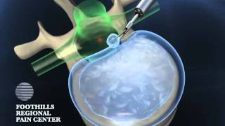 Fullendoscopic microdiscectomy for herniated disc transforaminal approach [upl. by Llyrpa]