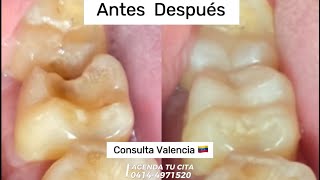 Endodoncia pasó a paso más reconstrucción indirecta y punto de contacto dental [upl. by Hacceber408]