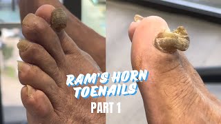 2 RAM’S HORN TOENAILS  PEDICURE PART 1 [upl. by Airliah124]