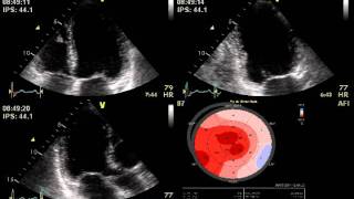 DOBUTAMINE STRESS ECHO MITRAL REGURGITATION  ECHOCARDIOGRAPHY cardiac ultrasound [upl. by Anod]