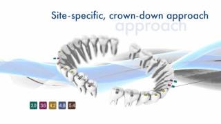 Astra Tech Implant System™ EV – Design philosophy  Dentsply Sirona [upl. by Sarnoff860]