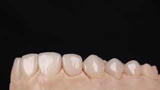 Making temporary dental veneers Mock up transfer [upl. by Pearce]