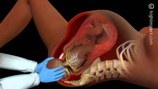 Brachial Plexus Injury [upl. by Vasileior]