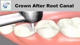 Dental Crown Procedure After Root Canal [upl. by Aillil]