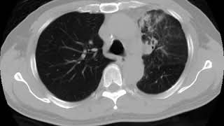 Lymphangitis carcinomatosis Ahuja AT et al 2017 Book Essential Radiology [upl. by Nguyen486]