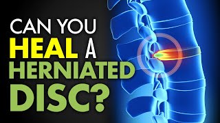 Can You Heal a Herniated Disc [upl. by Carlota370]