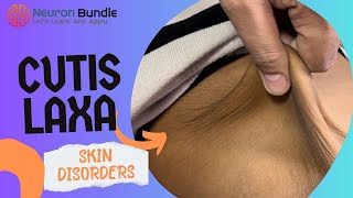 Cutis laxa  highly stretchable skin disorder connective tissue disorder  genetics [upl. by Nalced]