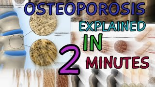 OSTEOPOROSIS  EXPLAINED IN 2 MINUTES  CAUSES  SYMPTOMS  TREATMENT  WHAT IS OSTEOPOROSIS [upl. by Nemra]