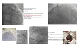 Interesting coronary angiograms [upl. by Dorlisa]