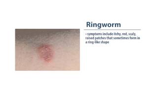 Skin Infections Ringworm [upl. by Ardnazil]