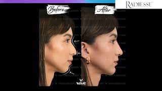 How to choose the best filler Juvederm vs Radiesse  Wave Plastic Surgery [upl. by Alle]