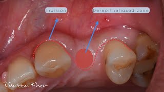 Buccal Roll Flap [upl. by Aramoj438]