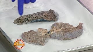 Here’s the Reality of How Smoking Affects Your Lungs… and It’s Not Pretty [upl. by Ecinnaj213]