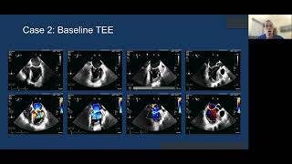 2022 Transcatheter Mitral Valve Replacement TMVR the Medtronic Intrepid system [upl. by Haet]