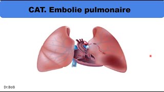 conduite à tenir devant une embolie pulmonaire [upl. by Nesiaj]