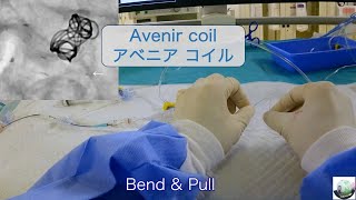 Avenir coil for cerebral aneurysms Bend amp Pull ワイヤー式デタッチャブルコイルの離脱 [upl. by Atalie]