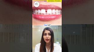 Do you have Teeth Gaps Watch this Dr Srishti Bhatia gaps smilemakeover teethgapmakeover [upl. by Carree131]