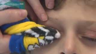 How to clean the eyelids in children and babies [upl. by Harri]