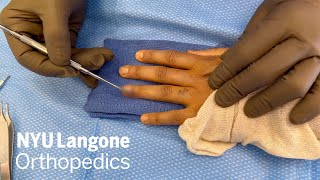 Excision of Glomus Tumor Using the Nailsparing Approach  NYU Langone Ortho  Dr Nader Paksima [upl. by Lib638]