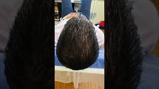 PRP Hair Treatment Results  See the Transformation [upl. by Arretak121]