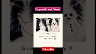 Congenital heat disease and their Characteristics shapes on radiograph heart defects neetpg [upl. by Ylrak]