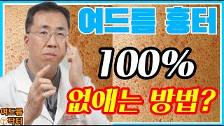 여드름 흉터❗100 없애는 방법❓ 여드름흉터 여드름흉터없애는방법 여드름흉터없애는법 여드름자국 [upl. by Hebel544]