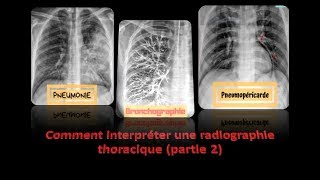 clichés thoraciques interprétés  partie 2  pneumologie radiologie [upl. by Dawes]