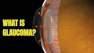 Glaucoma Signs and Treatment 3D Animation [upl. by Ajssatan233]