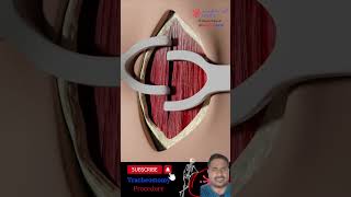 3D animation intubation procedure shorts youtubeshorts hospital viralvideo [upl. by Ehsom821]